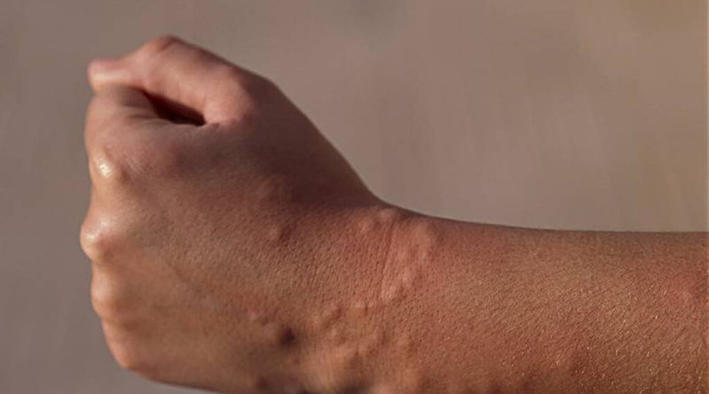 Tipus de mosquits que hi ha a Espanya i com identificar la seva picada