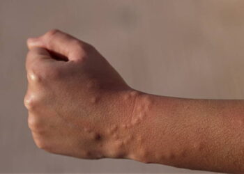 Tipus de mosquits que hi ha a Espanya i com identificar la seva picada